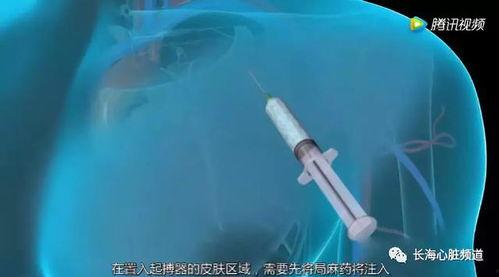 国产起搏器测评视频